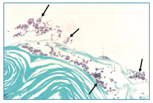 Cryptococcus neoformans in the sputum: a noninvasive diagnostic method.