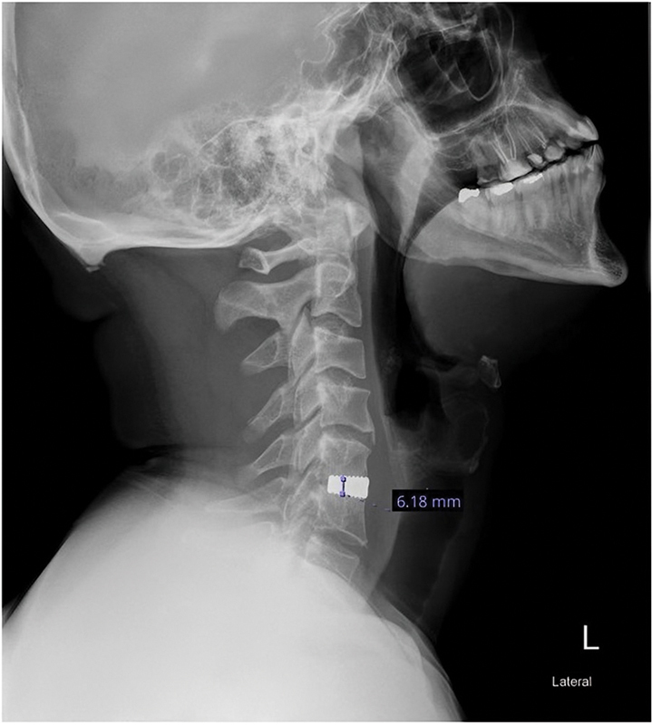 Comparative Radiological Outcomes of Stand-alone Cage versus Cage and Plate in Anterior Cervical Discectomy and Fusion: A Retrospective Cohort Study.