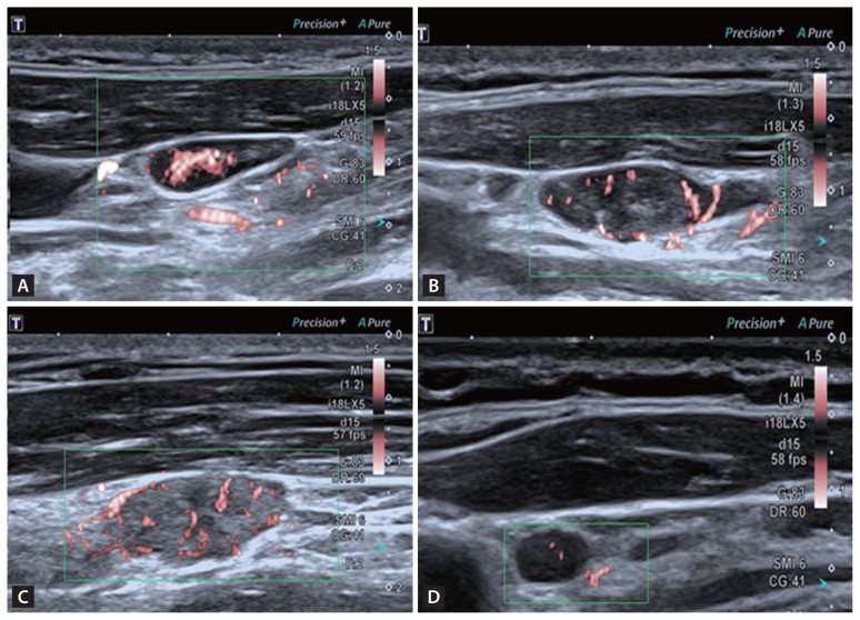 Fisher discriminant analysis of multimodal ultrasound in diagnosis of cervical metastatic lymph nodes in papillary thyroid cancer.