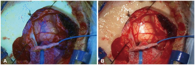 A Rare Case of Isolated Central Nervous System Neoplasm With Histiocytic Features.