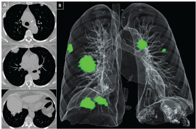 The Beauty and the Beast: pleural plaques due to asbestos exposure in a beauty salon worker. Who is guilty?