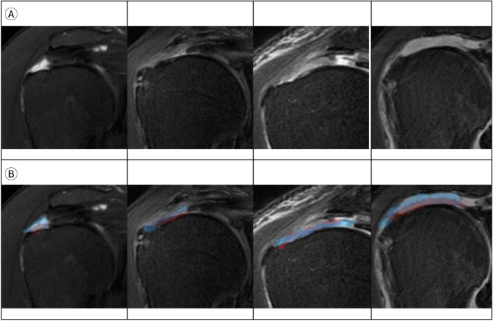 Application of deep learning for diagnosis of shoulder diseases in older adults: a narrative review.
