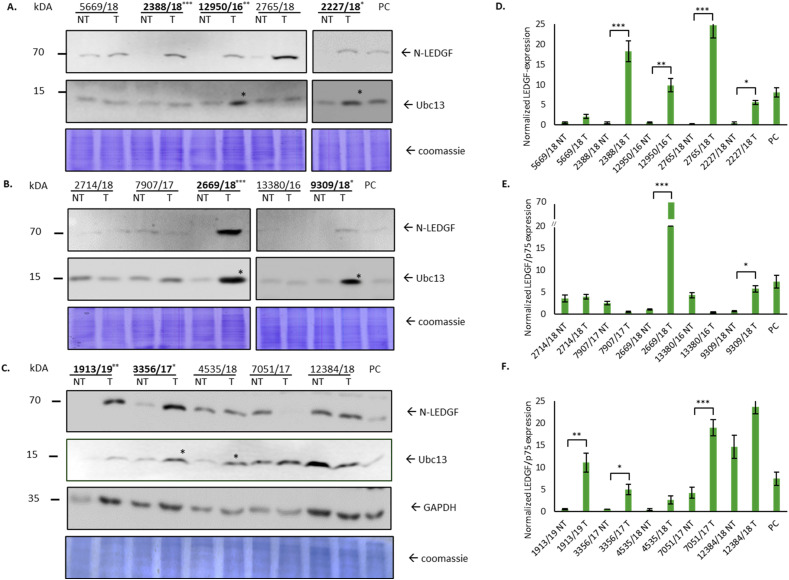 Linking LEDGF/p75 Overexpression With Microsatellite Instability and KRAS Mutations: A Small-Scale Study in Colorectal Cancer.