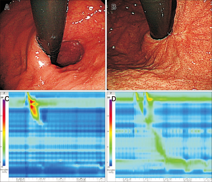 Effect of Anti-reflux Mucosal Ablation on Esophageal Motility in Patients With Gastroesophageal Reflux Disease: A Study Based on High-resolution Impedance Manometry.