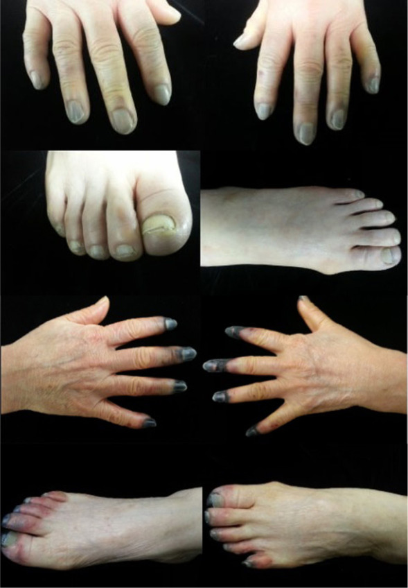 Determining the timing and extent of amputation in symmetrical peripheral gangrene: a report of three cases from Korea.