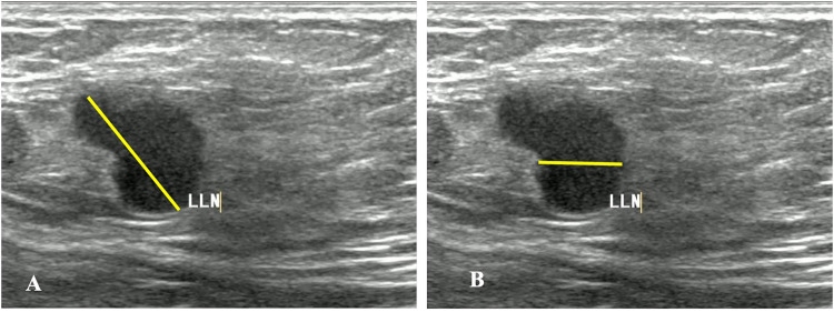 Enhancing Specificity in Predicting Axillary Lymph Node Metastasis in Breast Cancer through an Interpretable Machine Learning Model with CEM and Ultrasound Integration.