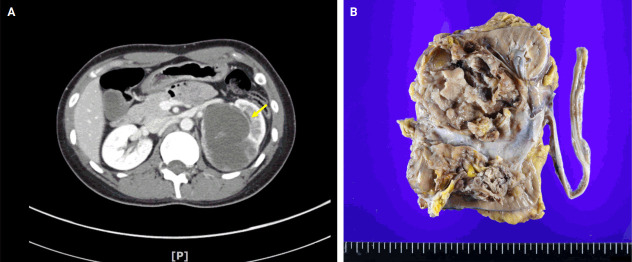 Primary renal BCOR::CCNB3 sarcoma in a female patient: case report.