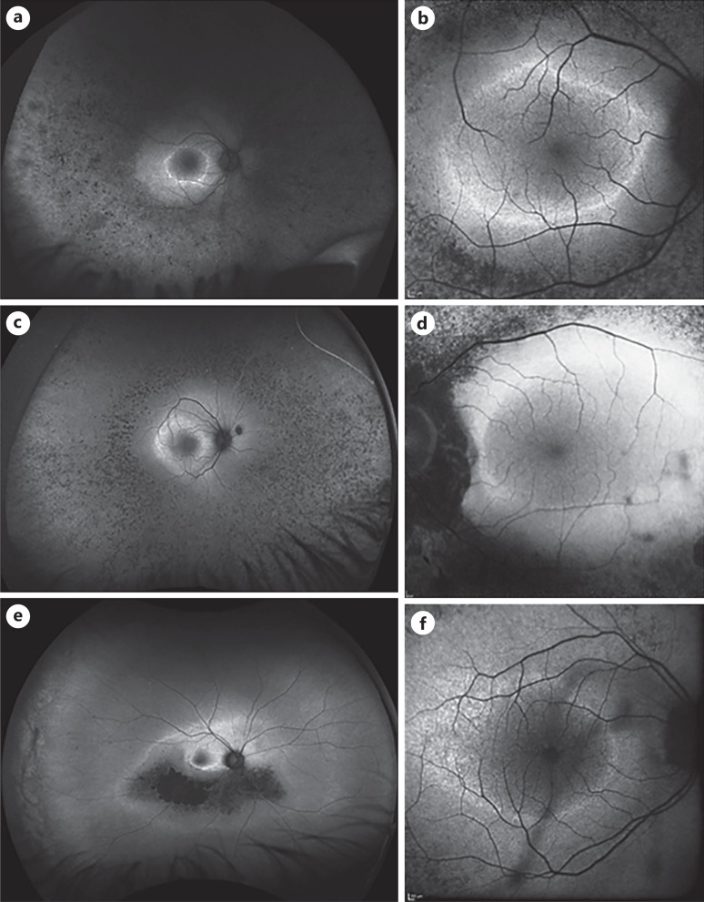 Characterization of Macular Fundus Autofluorescence Changes in Patients with Retinitis Pigmentosa.