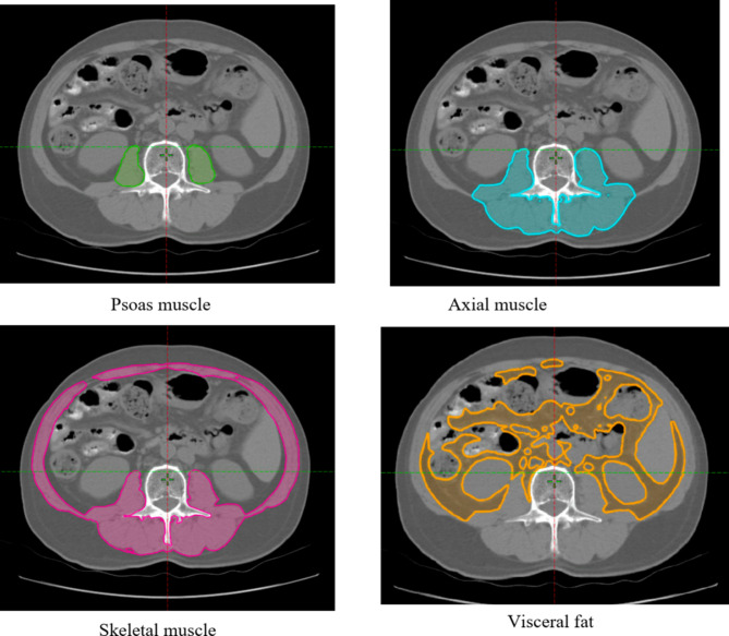 Preoperative myosteatosis and perioperative serum chloride levels predict 180 day major complications after radical cystectomy.