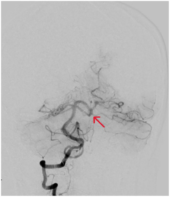 Idiopathic Secondary Eosinophilia: Revealing Cerebral Aneurysms as a Vascular Complication.