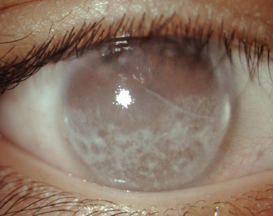 Juvenile idiopathic arthritis and associated uveitis: A review of pathogenesis, diagnosis, and management.