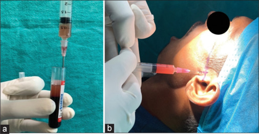 Evaluation of injectable platelet-rich fibrin (I-PRF) as a treatment in internal derangement of temporomandibular joint.