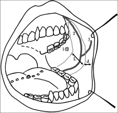 The outcomes of Facial Artery Musculomucosal (FAMM) flaps in oral oncologic reconstructions.