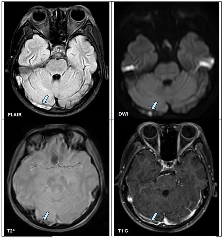 Protein-losing enteropathy as initial presentation of pediatric systemic lupus erythematosus: A rare case report from Vietnam and literature review.