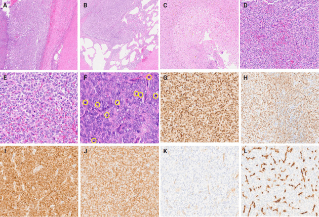 Primary renal BCOR::CCNB3 sarcoma in a female patient: case report.