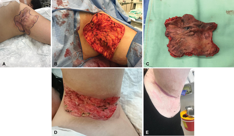 Immediate versus Delayed Wound Closure in Hidradenitis Suppurativa Surgery: A Comparative Outcomes Study.