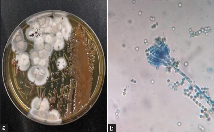 Pulmonary talaromycosis in a non-HIV individual-A rare case report from Southern India.