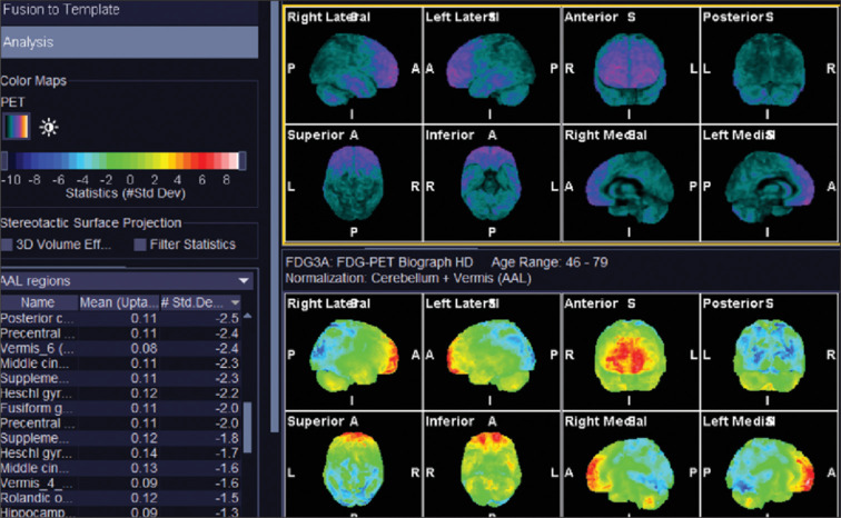 Autoimmune Encephalitis Pattern on PET-MRI in a Patient with Amyotrophic Lateral Sclerosis.