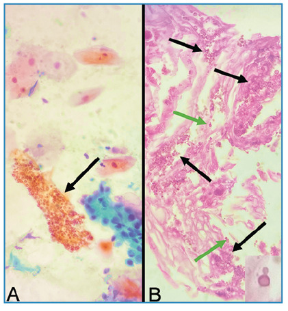 Cryptococcus neoformans in the sputum: a noninvasive diagnostic method.