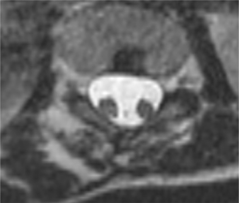 Split cord malformation - a simple, current classification based on CT and MRI neuroimaging studies.