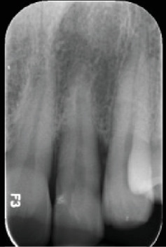 Successful Management of Palatal Developmental Groove-Associated Periodontal Defect Using Palatal Access Flap and Odontoradiculoplasty: A Case Report.
