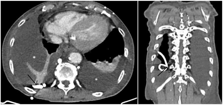 <i>Ascaris lumbricoides</i> Emerging from a PleurX Draining Catheter: An Unexpected Diagnosis.