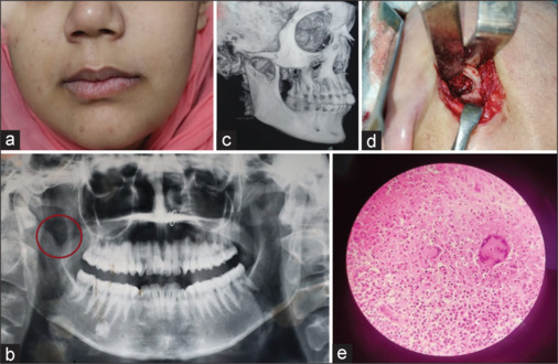 Tubercular osteomyelitis of mandible: Defining diagnostic criteria.