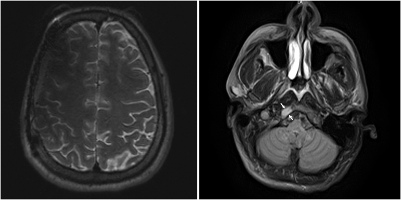 Malignant Paraganglioma With Calvarial Metastases Presenting With Recurrent Catecholamine-Induced Cardiomyopathy