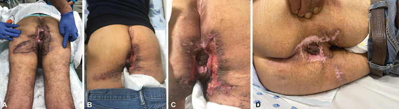 Immediate versus Delayed Wound Closure in Hidradenitis Suppurativa Surgery: A Comparative Outcomes Study.