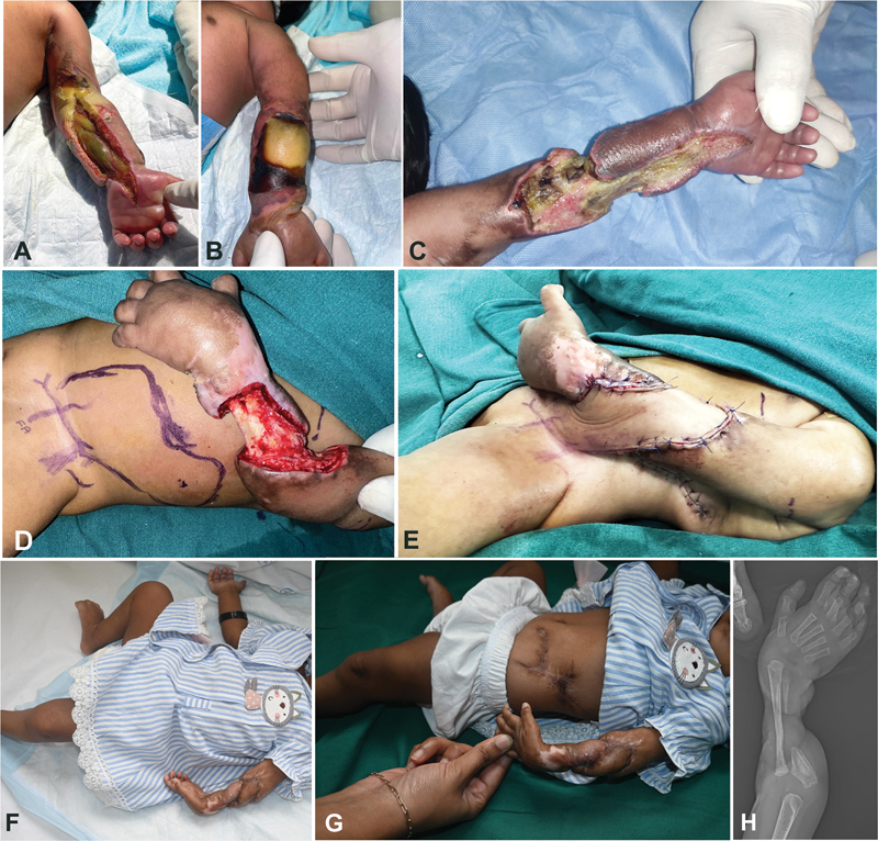 Pedicled Abdominal Flap in the Youngest Patient Yet? A Case Report of a Newborn with Neonatal Compartment Syndrome.