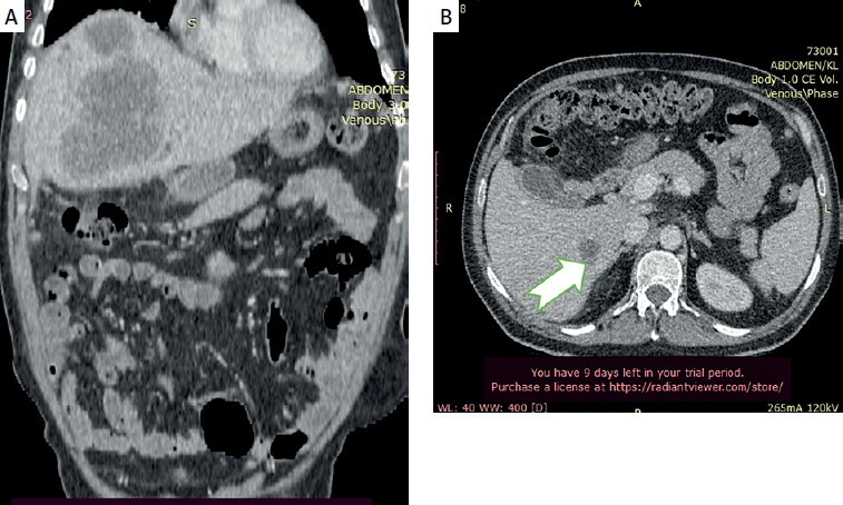 Primary squamous cell carcinoma of the liver.