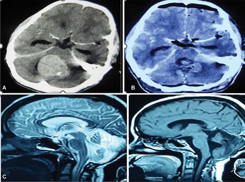 Cerebellar Mutism/Posterior Fossa Syndrome Following Resection of Posterior Fossa Tumor in Pediatric Patients: Assessing Pathophysiology, Risk Factors, and Neuroradiographic Features.