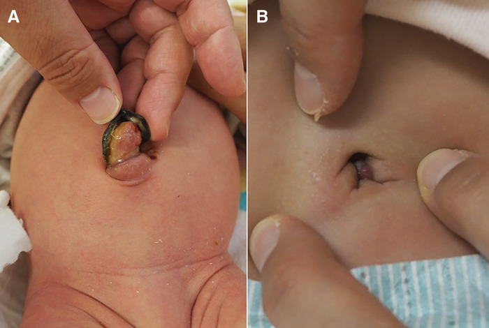 Coexisting Remnants of the Omphalomesenteric Duct and Urachus in an Infant.