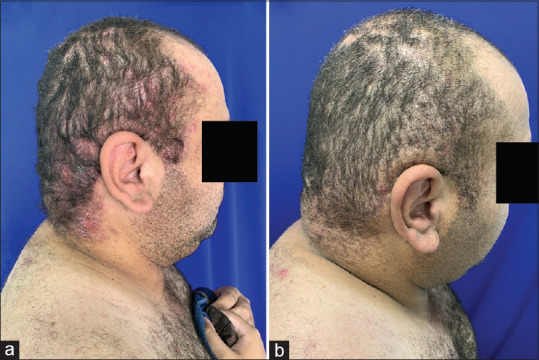 Refractory Folliculitis Decalvans: New Therapeutic Horizons?