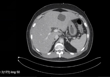 Typhoid Fever as a Cause of Liver Failure in the United States: A Case Report.