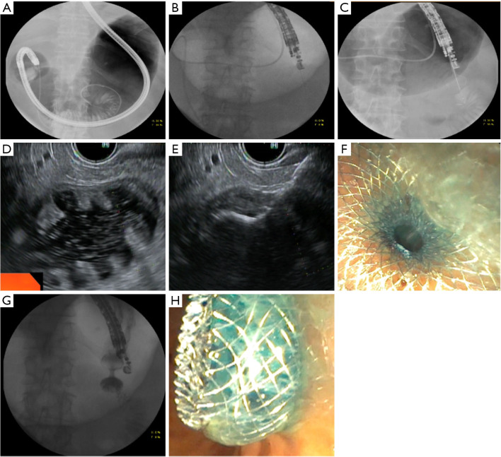 Endoscopic ultrasound-guided gastroenterostomy: a review.