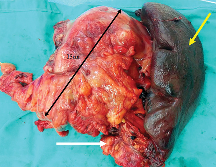 A Large Gastrointestinal Stromal Tumor under the Disguise of a Gastric Diverticulum: Report of a Case and Review of the Literature.
