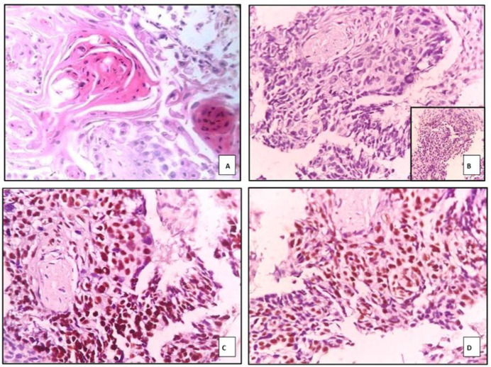 Evaluation of TTF-1, Napsin A, p40, and p63 in the Subtyping of Non-Small Cell Lung Carcinoma: A Cross-Sectional Study from India.