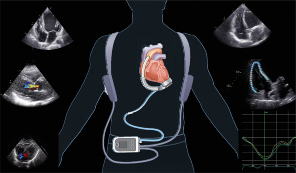 How to Do Echo in Left Ventricular Assist Device Candidates: A Consensus Statement of the Italian Society of Echocardiography and Cardiovascular Imaging.