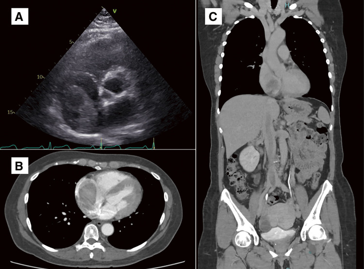 Intravenous Leiomyomatosis of the Uterus Extending to the Right Atrium: A Case Report.