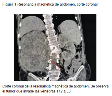 [Doege-Potter syndrome and intra-abdominal giant solitary fibrous tumor: Case report].