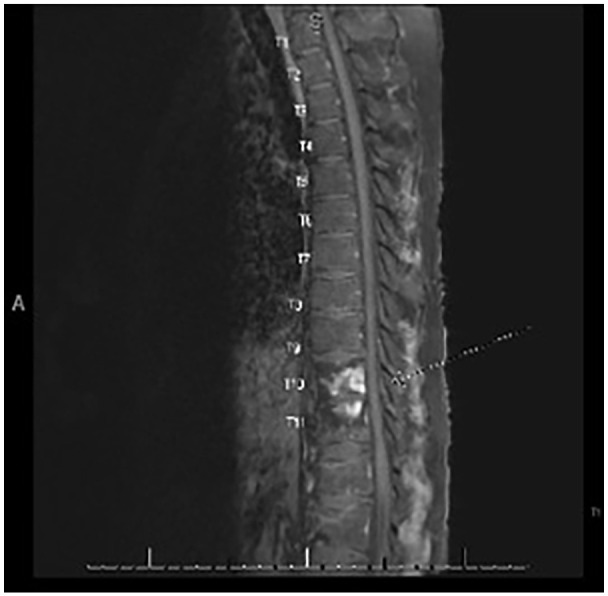 A Case of Tuberculous Meningitis With Concomitant Spinal Co-infection With Tuberculosis and <i>Aspergillosis</i>.
