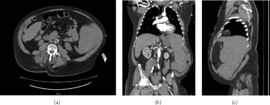 A Case of Atraumatic Splenic Rupture Due to T-Cell/Histiocyte-Rich Large B-Cell Lymphoma and a Potential Role for Massive Transfusion Protocol.