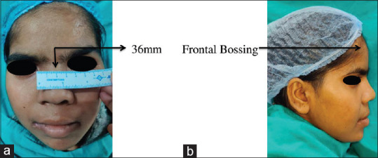 Navigating Beyond a Cyst: The Intricate World of Gorlin Goltz Syndrome - A Case Report.