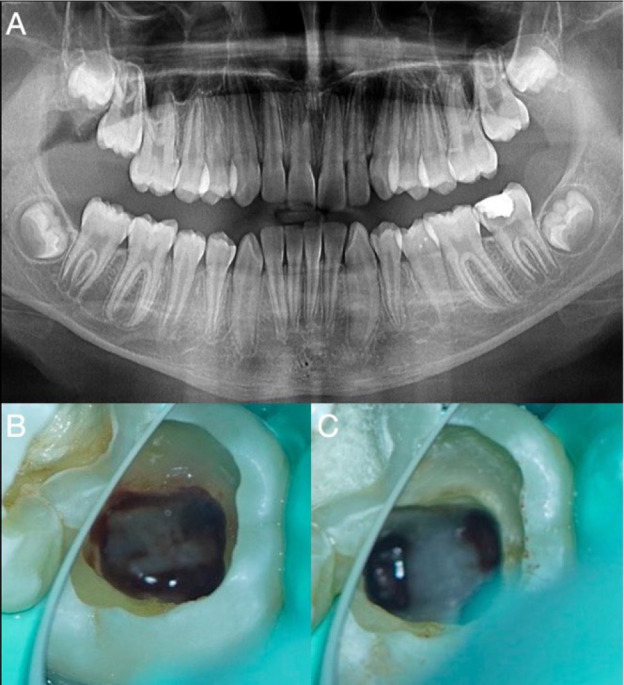 The Impact of Vital Pulp Therapy on Normal Root Development in Immature Teeth: A Case Report.