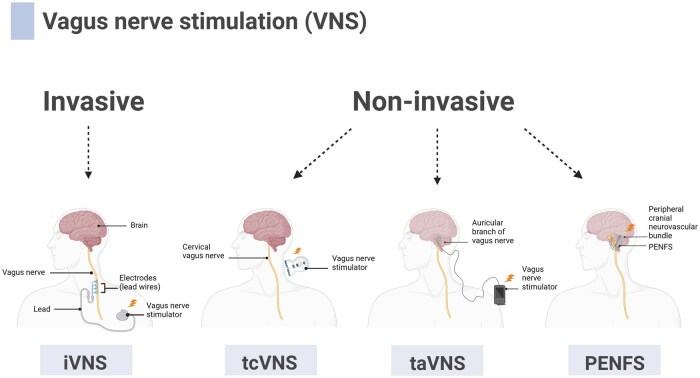 Efficacy of vagus nerve stimulation in gastrointestinal disorders: a systematic review.
