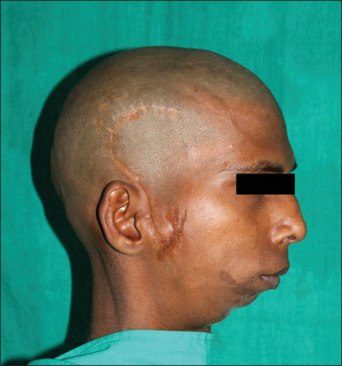 Patient-Specific surgical management of a triad of TMJ ankylosis, micrognathia, and obstructive sleep apnea: A case report.