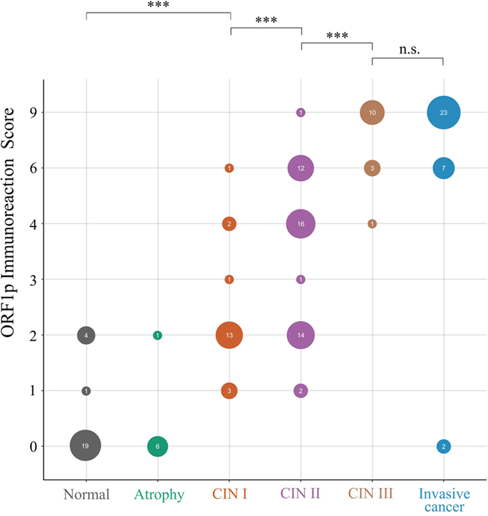 LINE-1 ORF1p is a Promising Biomarker in Cervical Intraepithelial Neoplasia Degree Assessment.