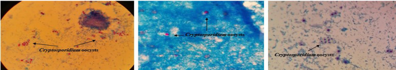 Pulmonary Cryptosporidiosis in HIV Infected Patients at Imam Khomeini Complex Hospital in Tehran, Iran: A Case Series.