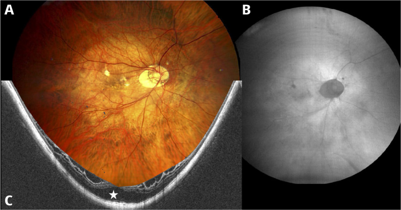 Management of myopic traction maculopathy.